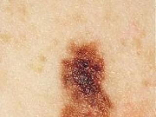 Melanoma, a rosszindulatú bőrrák