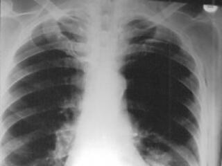 Halálos betegség! - 5 jel, amely arra utal, hogy te is veszélyben vagy!