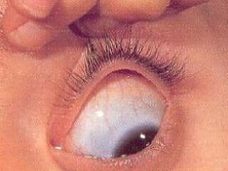 Ő,aki összeroppant csontokkal született! Porcelán ember