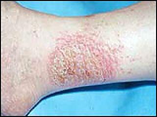 Hogyan ismerhető fel, ha ekcémás a bőrünk?