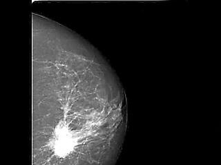 Életmentő gyógyszer a mellrákosoknak!