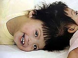 Sziámi ikrek mindig is voltak