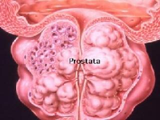 Vigyázz! Ezek a prosztatarák tünetei!