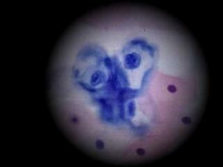A rettegett HPV vírus