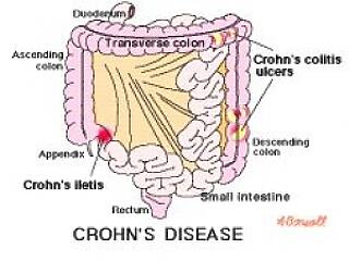 5 vészjósló jel: komoly baj van a vastagbeleddel!