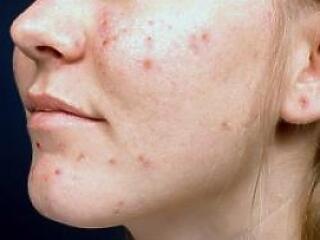 Búcsú a pattanásoktól?