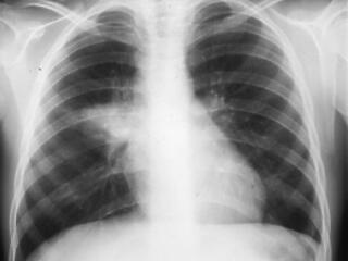 Nem elhallgatható! Megint itt a tuberkolózis!