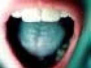 Fontos tudnivalók a szájüregi rákokról!