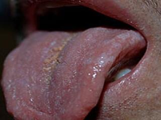 HIV fertőzés tünetei a szájban