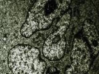 Minden, amit tudnia kell erről a komoly betegségről!