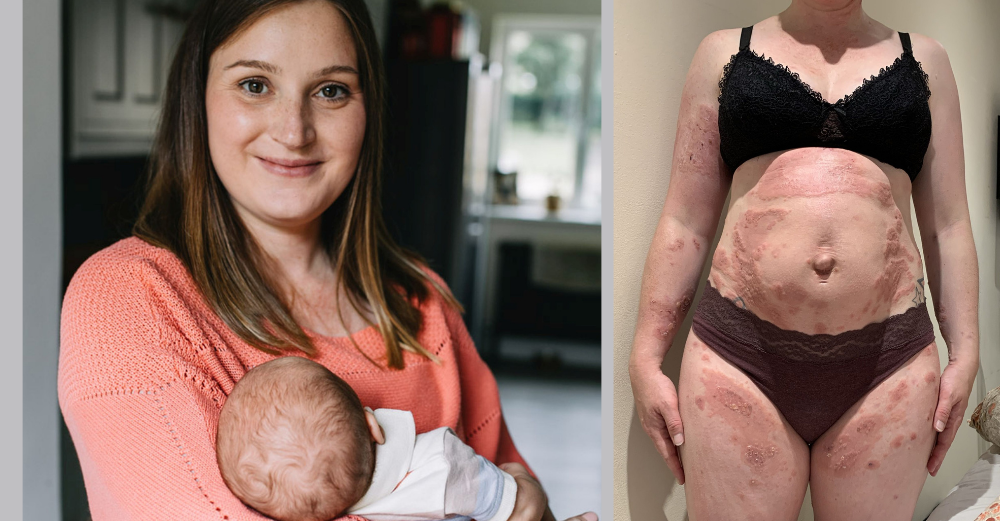 Saját babájára lett allergiás egy kismama